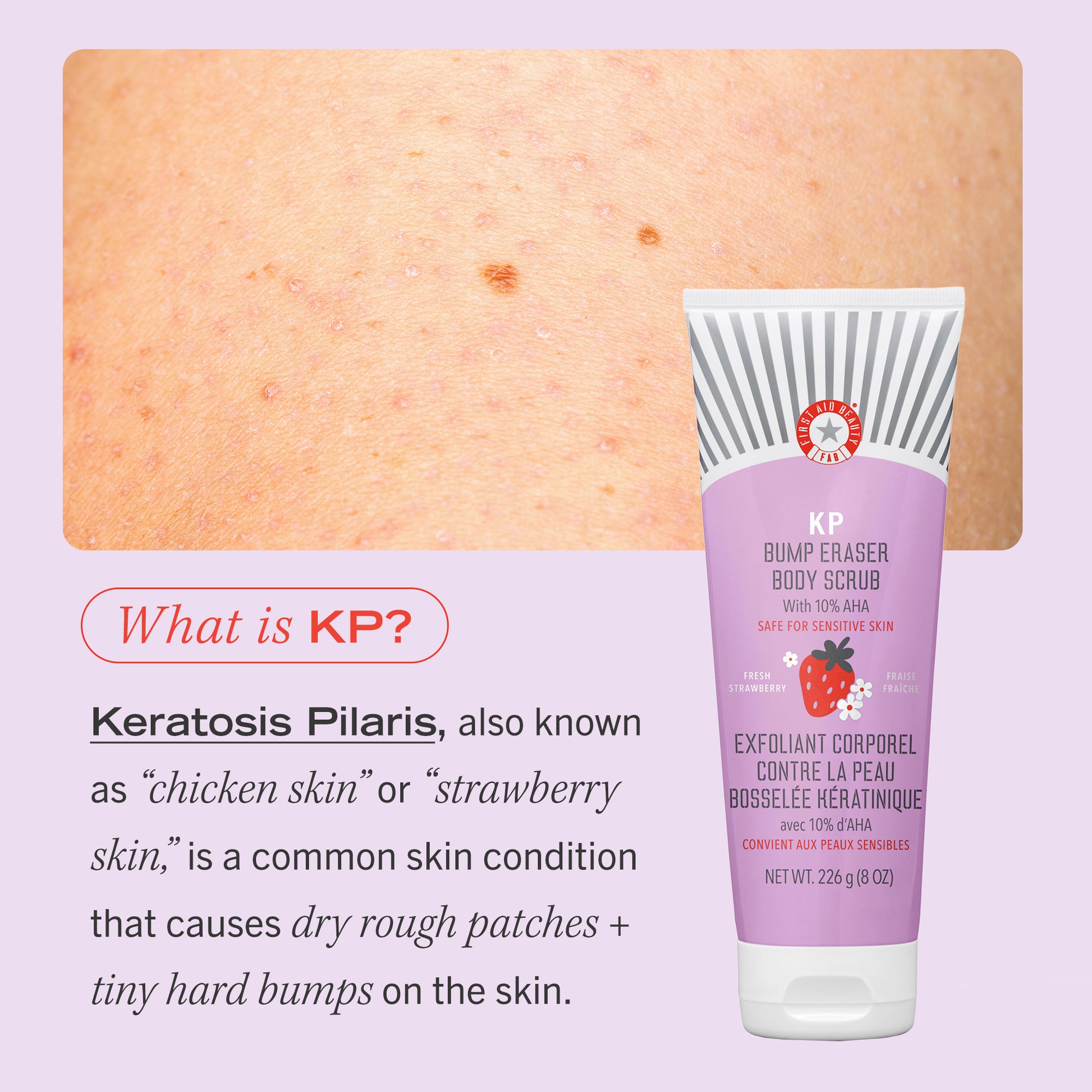 What is KP?  Keratosis Pilaris, also known as "chicken skin" or "strawberry skin," is a common skin condition that causes dry rough patches + tiny hard bumps on the skin.