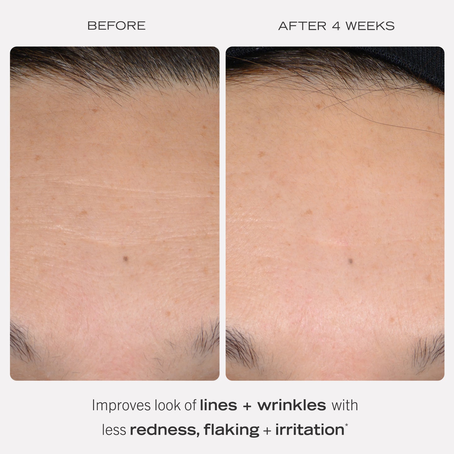 Face Before and After 4 Weeks of using Retinol. Improves look of lines + wrinkles with less redness, flaking + irritation