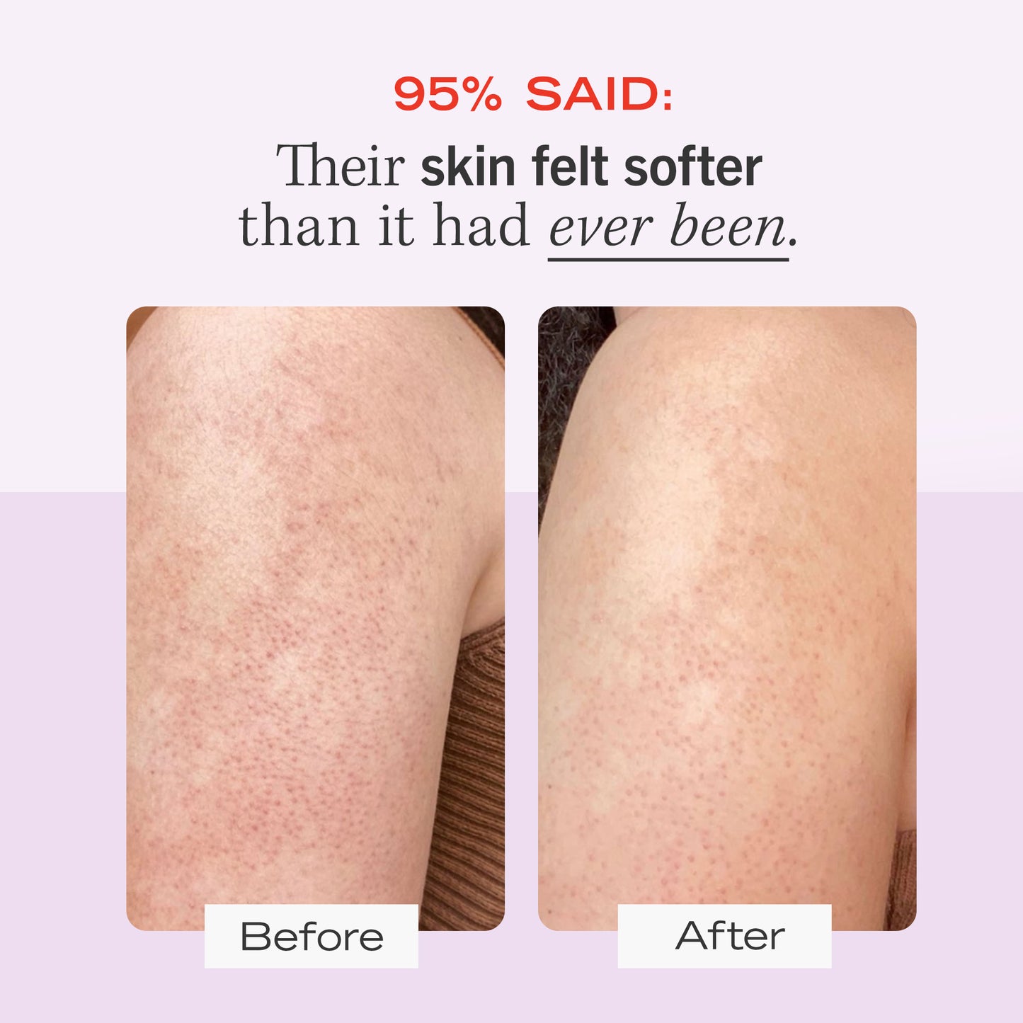 Skin on arm Before and After using KP Bump Eraser Body Scrub.  95% Said: Their skin felt softer than it had ever been.