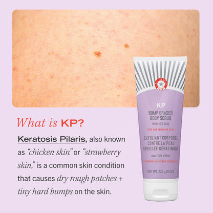 What is KP? Keratosis Pilaris, also known as "chicken skin" or "strawberry skin," is a common skin condition that causes dry rough patches + tiny hard bumps on the skin.