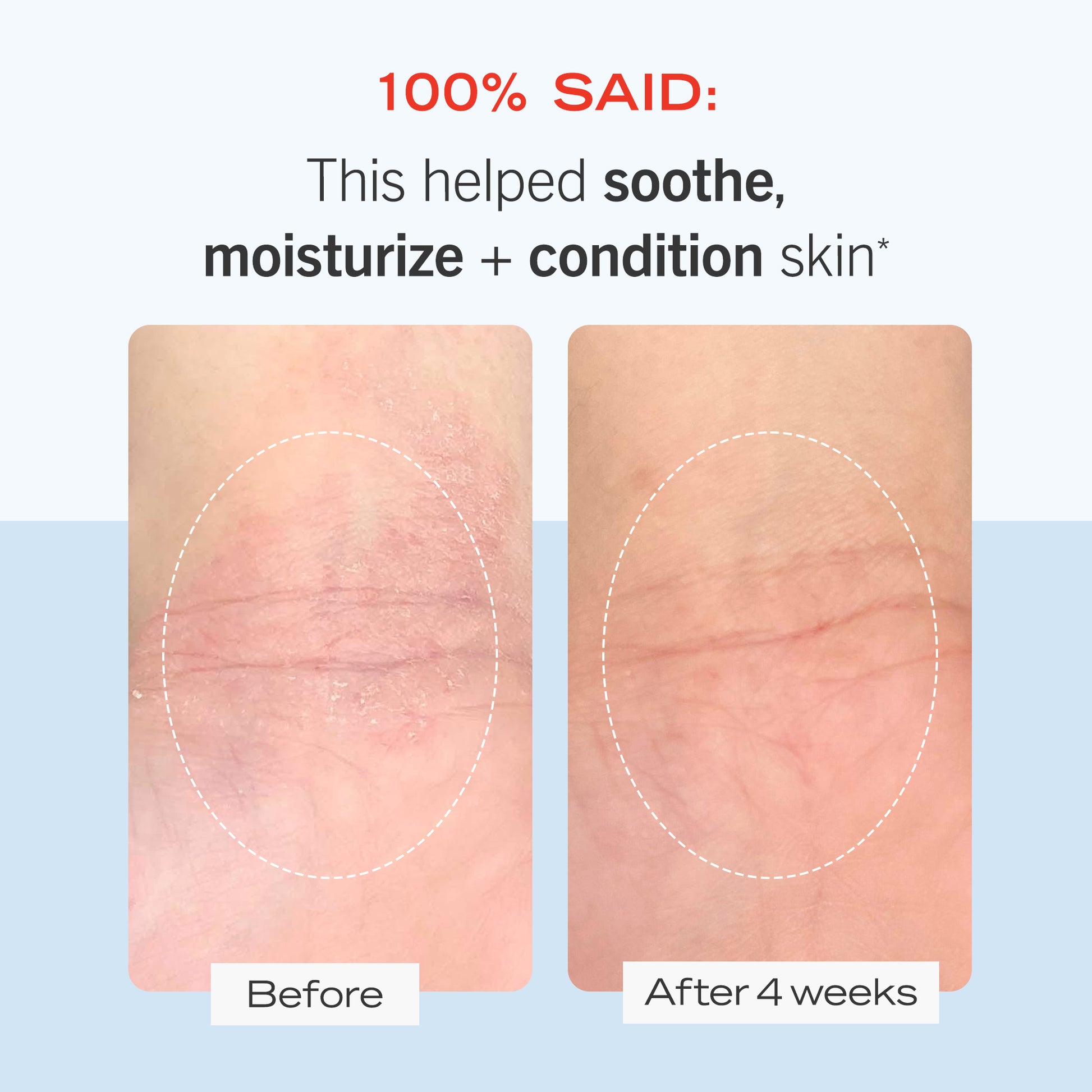 Skin Before and After 4 weeks of using Ultra Repair Cream.  100% said: This helped soothe, moisture + condition skin.